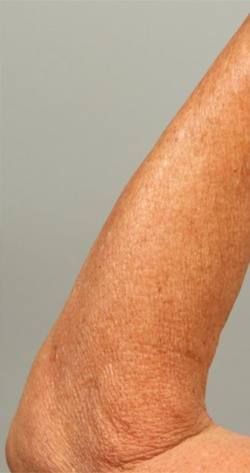 Microneedling Before & After Gallery - Patient 153339 - Image 2