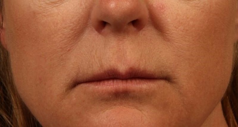 Microneedling Before & After Gallery - Patient 285667 - Image 1