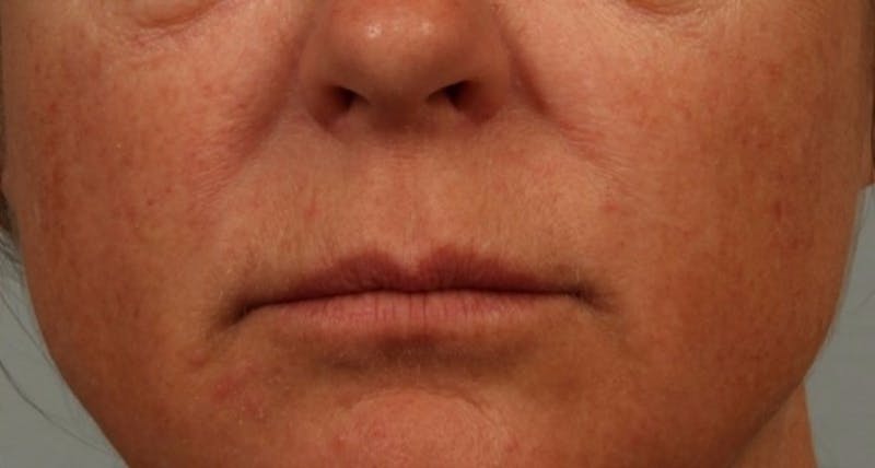 Microneedling Before & After Gallery - Patient 285667 - Image 2