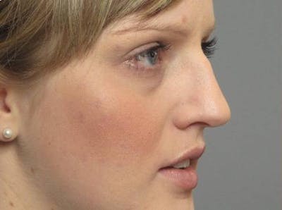 Rhinoplasty Before & After Gallery - Patient 187523 - Image 1