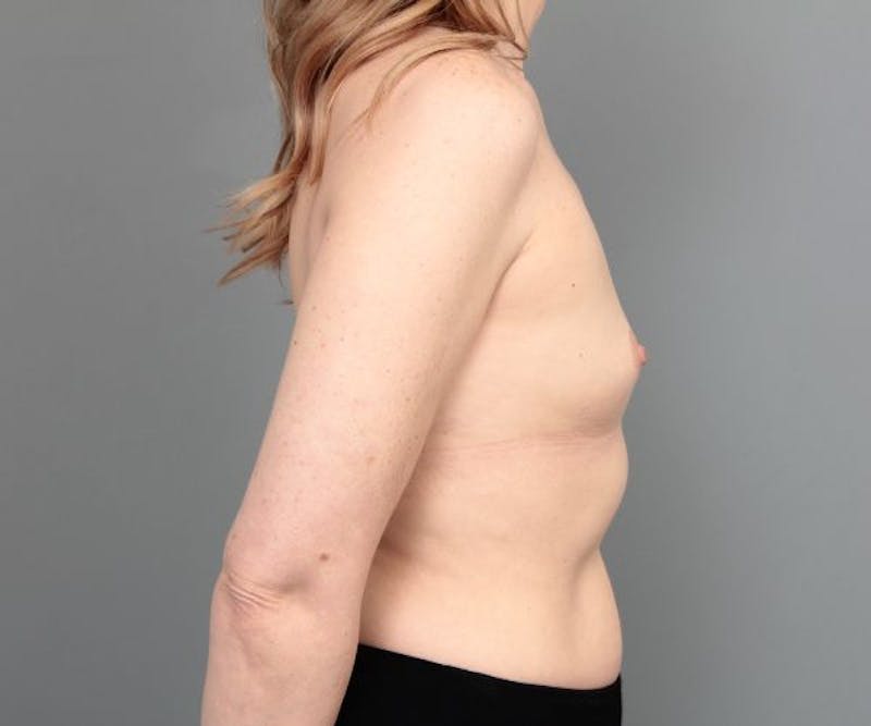 Breast Augmentation Before & After Gallery - Patient 198044 - Image 5 - Scott Chapin, MD