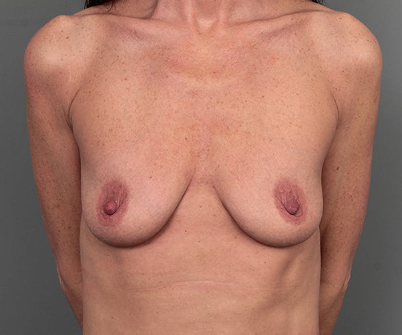 Breast Augmentation Before & After Gallery - Patient 193811 - Image 1 - Scott Chapin, MD