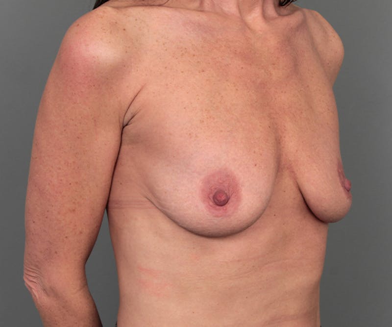 Breast Augmentation Before & After Gallery - Patient 193811 - Image 5 - Scott Chapin, MD