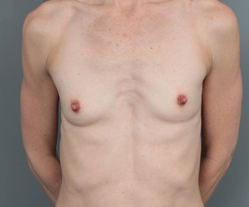 Breast Augmentation Before & After Gallery - Patient 421553 - Image 1 - Scott Chapin, MD