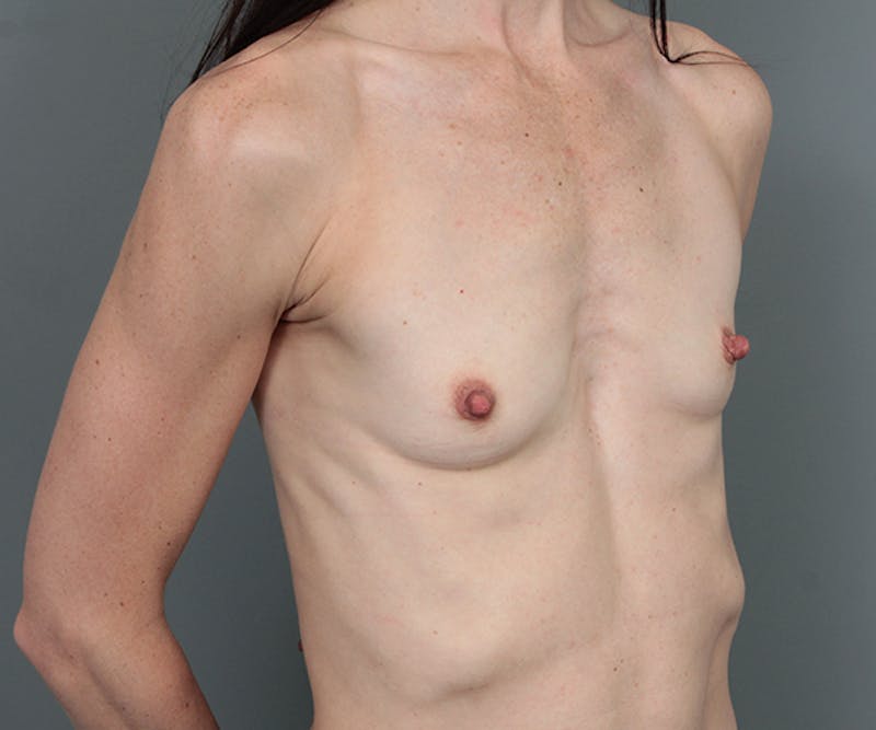 Breast Augmentation Before & After Gallery - Patient 421553 - Image 5 - Scott Chapin, MD