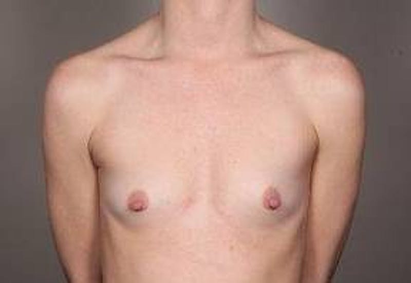 Breast Augmentation Before & After Gallery - Patient 427865 - Image 1 - Scott Chapin, MD