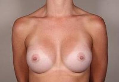 Breast Augmentation Before & After Gallery - Patient 427865 - Image 2 - Scott Chapin, MD
