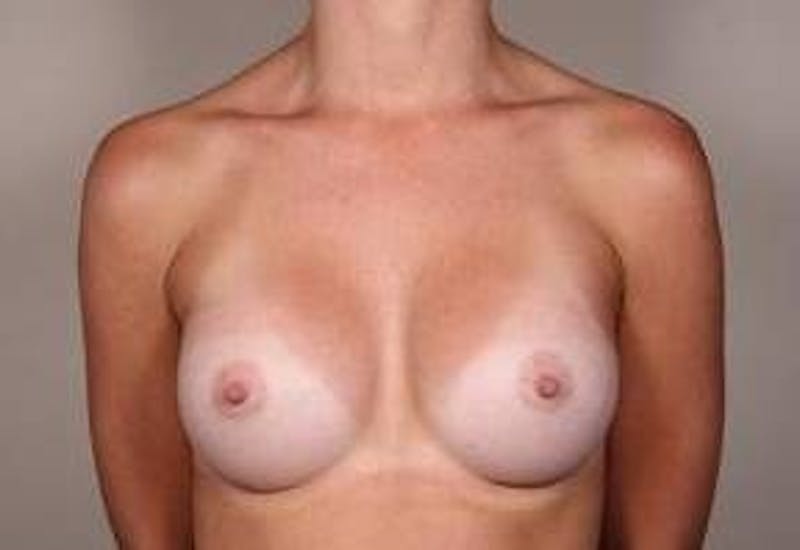 Breast Augmentation Before & After Gallery - Patient 427865 - Image 2 - Scott Chapin, MD