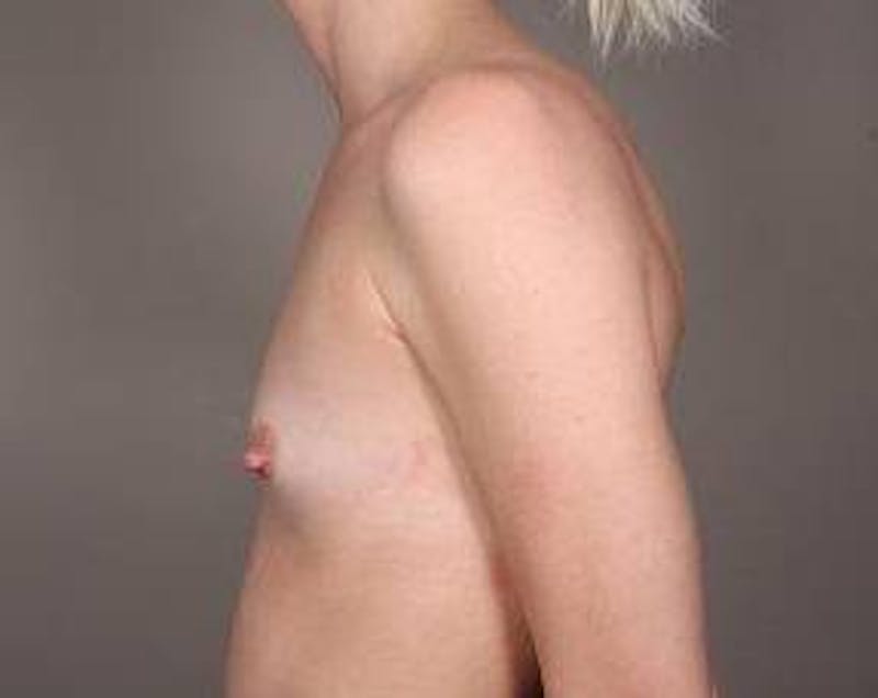 Breast Augmentation Before & After Gallery - Patient 427865 - Image 3 - Scott Chapin, MD
