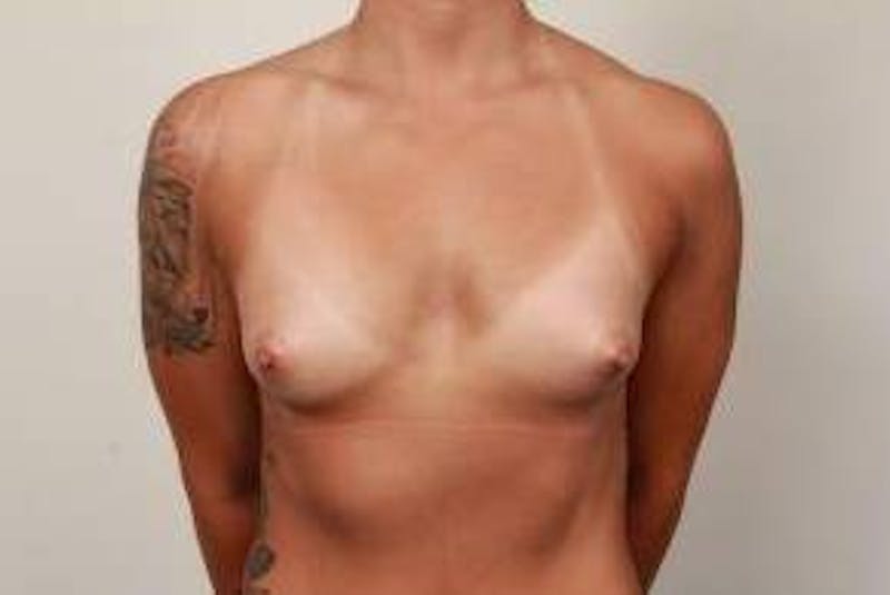Breast Augmentation Before & After Gallery - Patient 287677 - Image 1 - Scott Chapin, MD