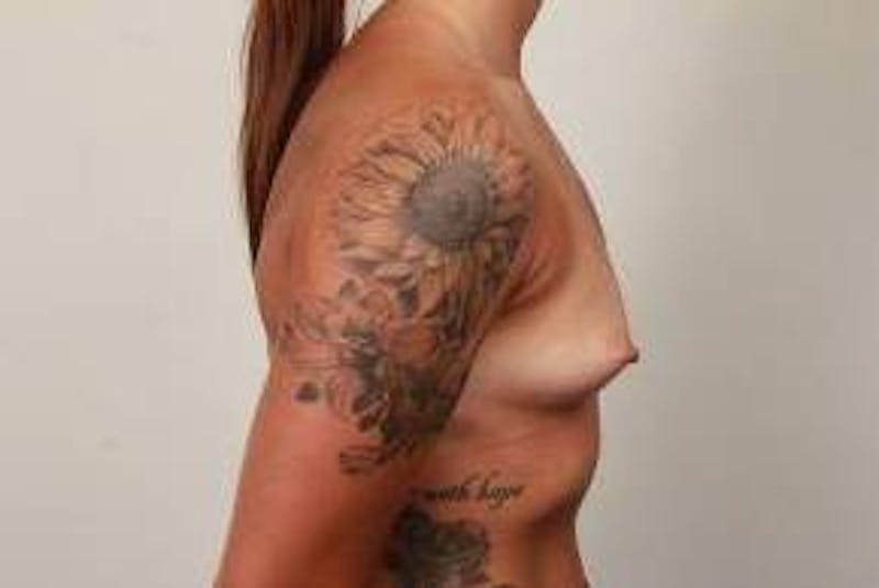 Breast Augmentation Before & After Gallery - Patient 287677 - Image 3 - Scott Chapin, MD