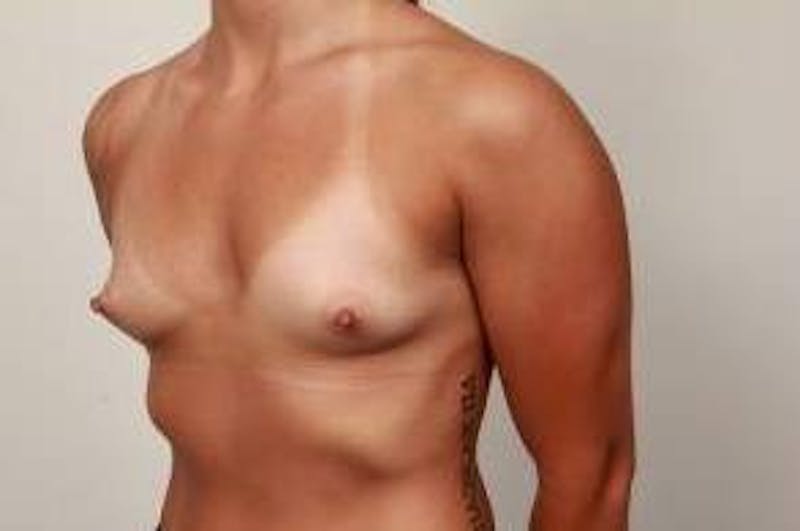 Breast Augmentation Before & After Gallery - Patient 287677 - Image 5 - Scott Chapin, MD