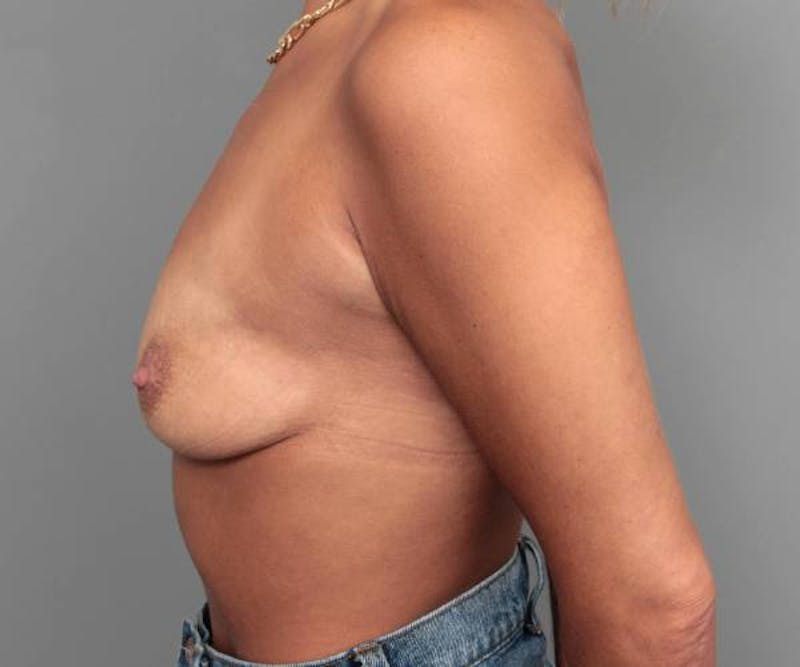 Breast Augmentation Before & After Gallery - Patient 131284 - Image 5 - Scott Chapin, MD