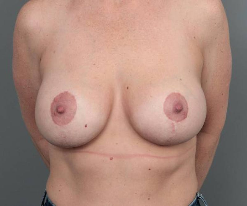 Breast Augmentation Before & After Gallery - Patient 219561 - Image 2 - Scott Chapin, MD