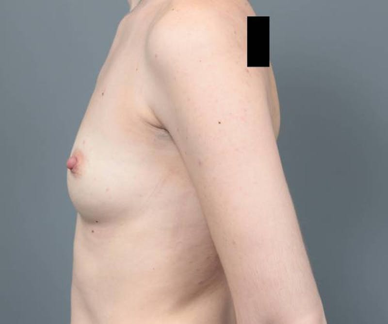Breast Augmentation Before & After Gallery - Patient 217396 - Image 5 - Scott Chapin, MD