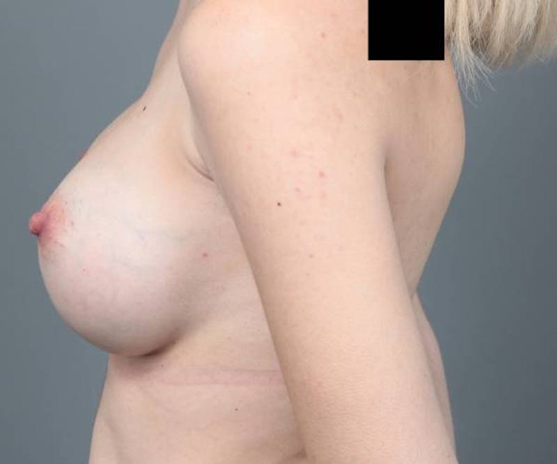 Breast Augmentation Before & After Gallery - Patient 217396 - Image 6 - Scott Chapin, MD