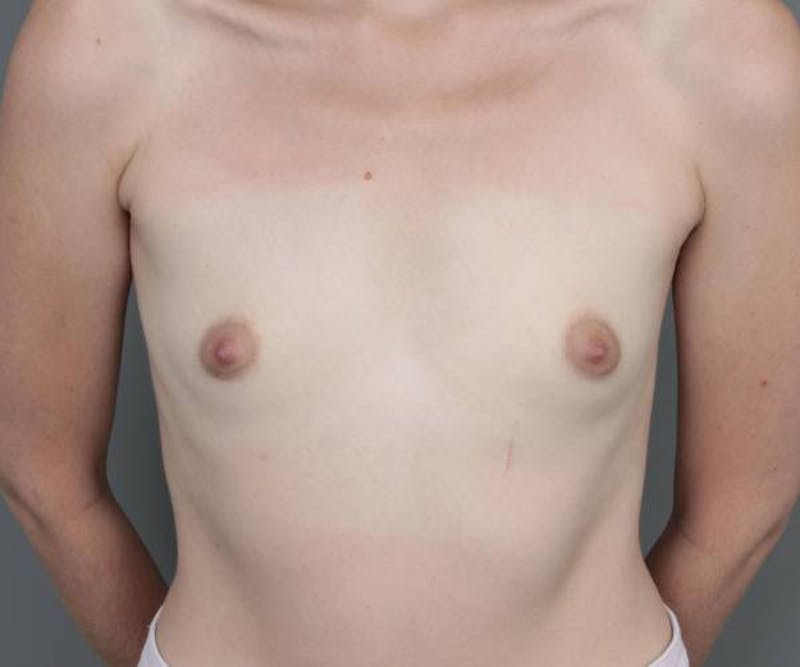 Breast Augmentation Before & After Gallery - Patient 191599 - Image 1 - Scott Chapin, MD