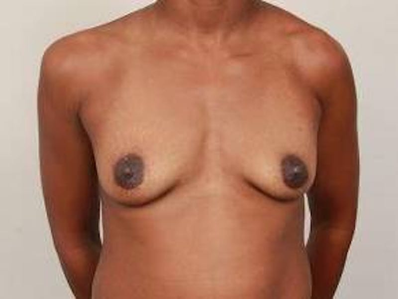 Breast Augmentation Before & After Gallery - Patient 119895 - Image 1 - Scott Chapin, MD