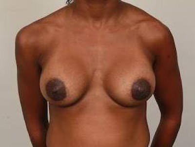 Breast Augmentation Before & After Gallery - Patient 119895 - Image 2 - Scott Chapin, MD