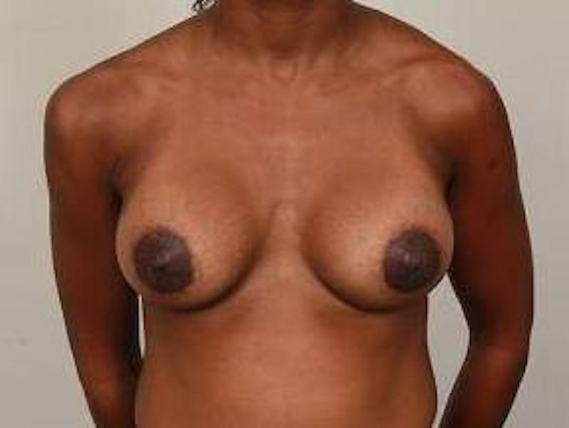 Breast Augmentation Before & After Gallery - Patient 119895 - Image 2 - Scott Chapin, MD