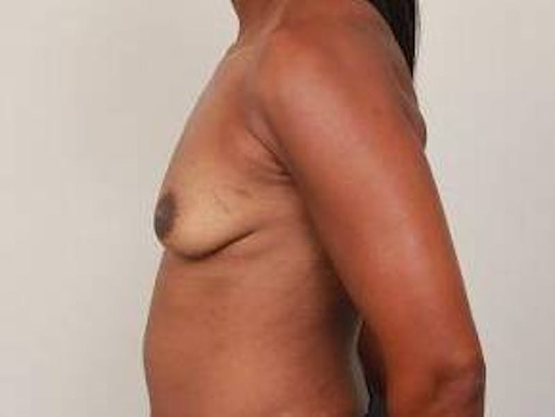 Breast Augmentation Before & After Gallery - Patient 119895 - Image 3 - Scott Chapin, MD