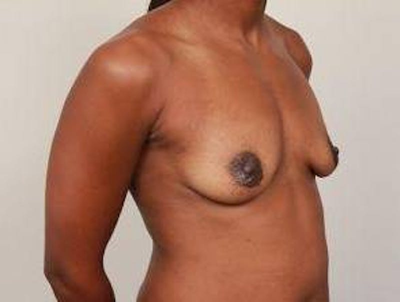 Breast Augmentation Before & After Gallery - Patient 119895 - Image 5 - Scott Chapin, MD