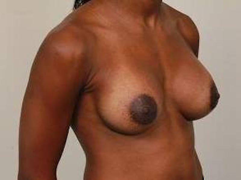 Breast Augmentation Before & After Gallery - Patient 119895 - Image 6 - Scott Chapin, MD