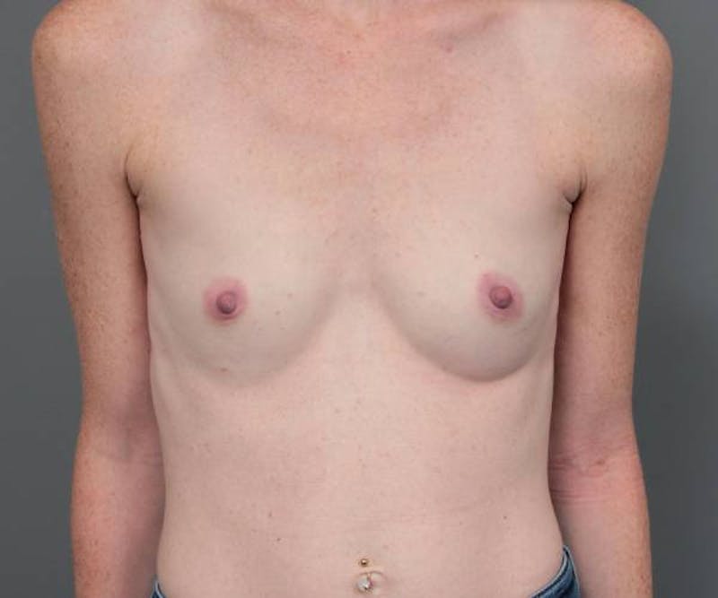 Breast Augmentation Before & After Gallery - Patient 307570 - Image 1 - Scott Chapin, MD