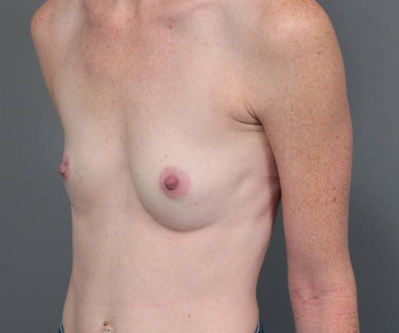 Breast Augmentation Before & After Gallery - Patient 307570 - Image 3 - Scott Chapin, MD