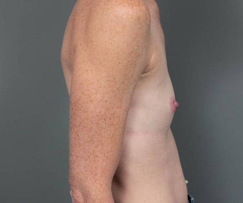 Breast Augmentation Before & After Gallery - Patient 307570 - Image 5 - Scott Chapin, MD