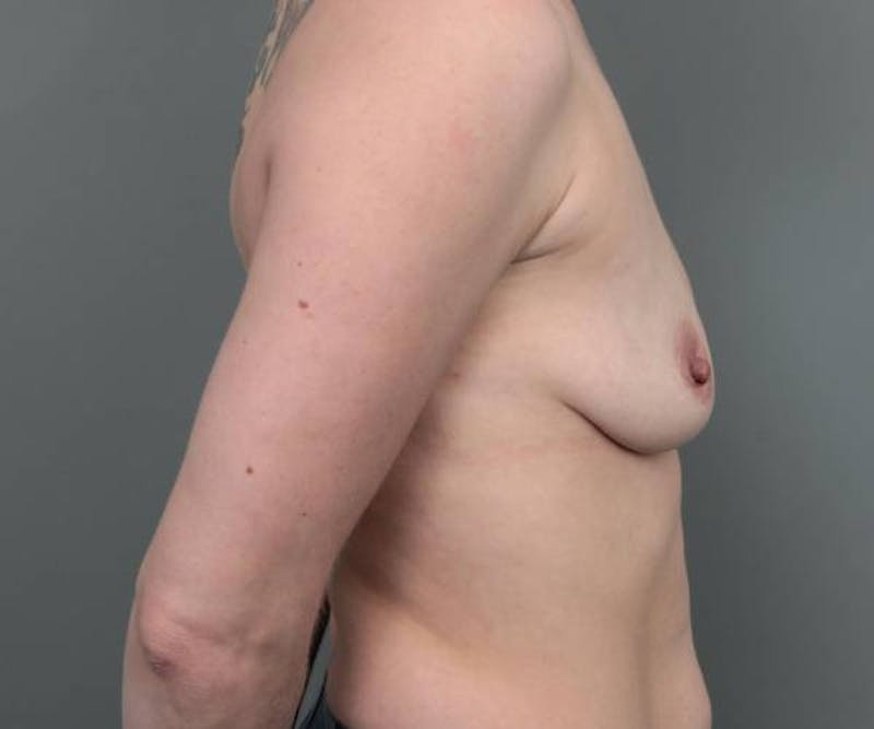Breast Augmentation Before & After Gallery - Patient 195476 - Image 5 - Scott Chapin, MD