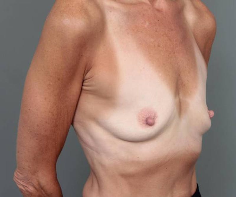 Breast Augmentation Before & After Gallery - Patient 239155 - Image 3 - Scott Chapin, MD