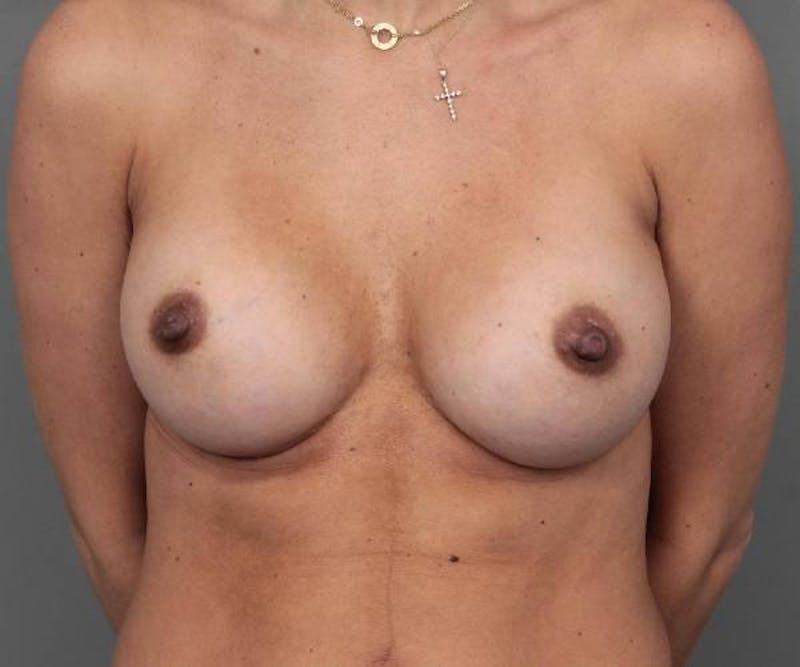 Breast Augmentation Before & After Gallery - Patient 197176 - Image 2 - Scott Chapin, MD