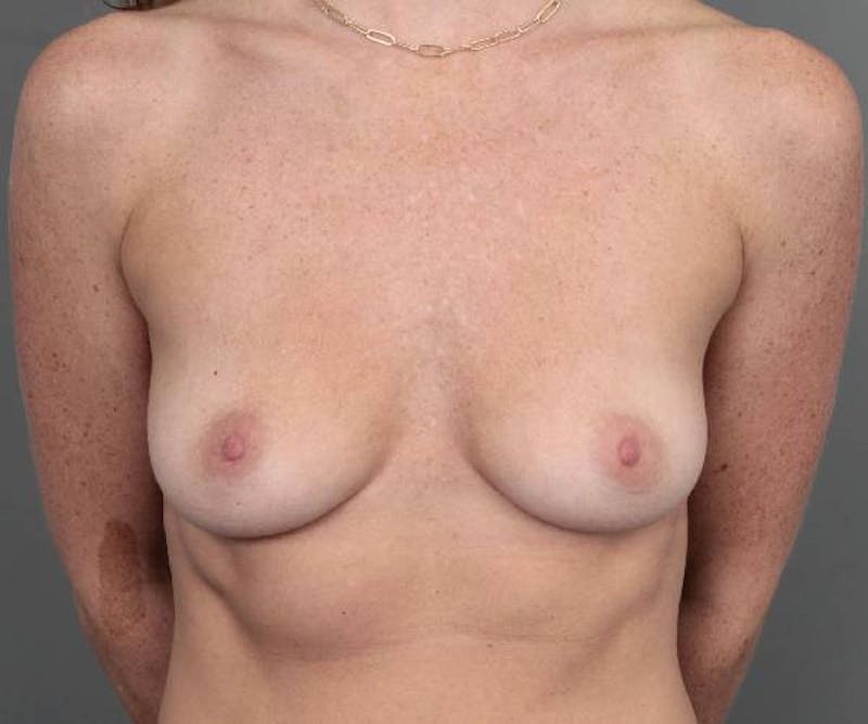 Breast Augmentation Before & After Gallery - Patient 150804 - Image 1 - Scott Chapin, MD