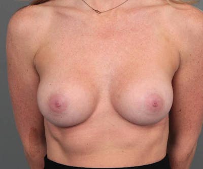 Breast Augmentation Before & After Gallery - Patient 150804 - Image 2 - Scott Chapin, MD