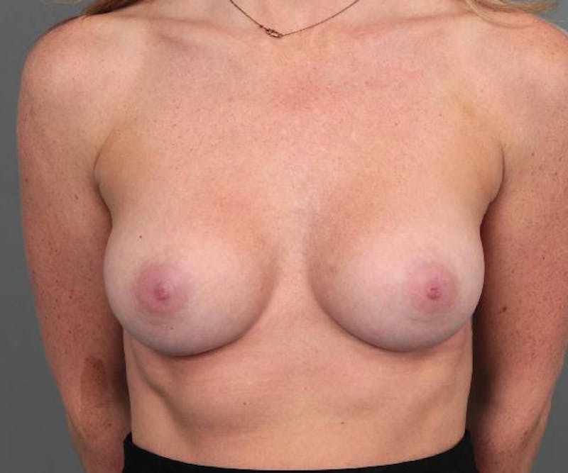 Breast Augmentation Before & After Gallery - Patient 150804 - Image 2 - Scott Chapin, MD