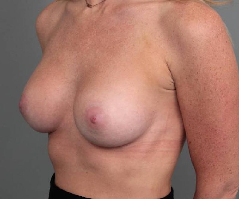 Breast Augmentation Before & After Gallery - Patient 150804 - Image 4 - Scott Chapin, MD