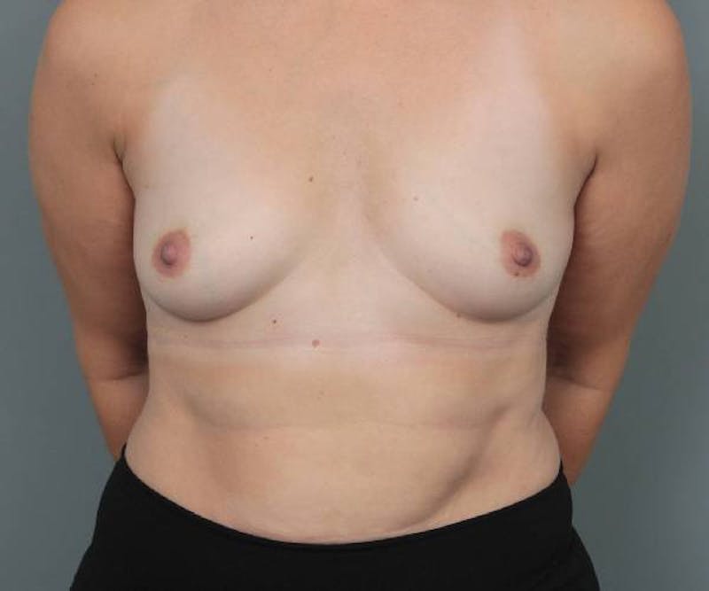 Breast Augmentation Before & After Gallery - Patient 217962 - Image 1 - Scott Chapin, MD