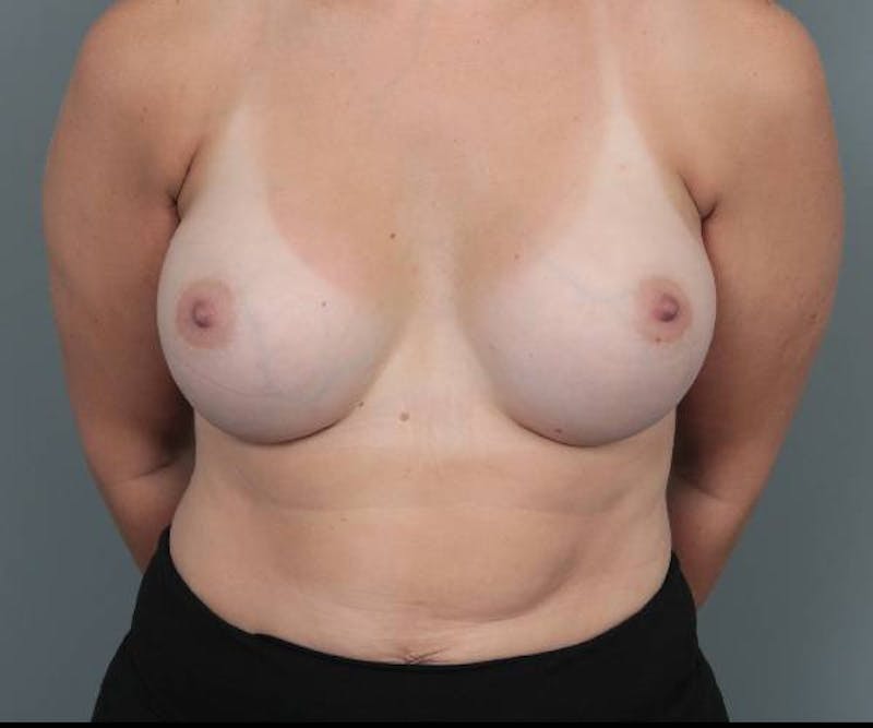 Breast Augmentation Before & After Gallery - Patient 217962 - Image 2 - Scott Chapin, MD