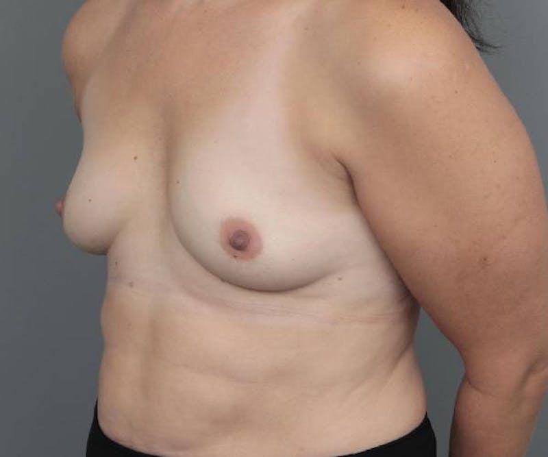 Breast Augmentation Before & After Gallery - Patient 217962 - Image 3 - Scott Chapin, MD