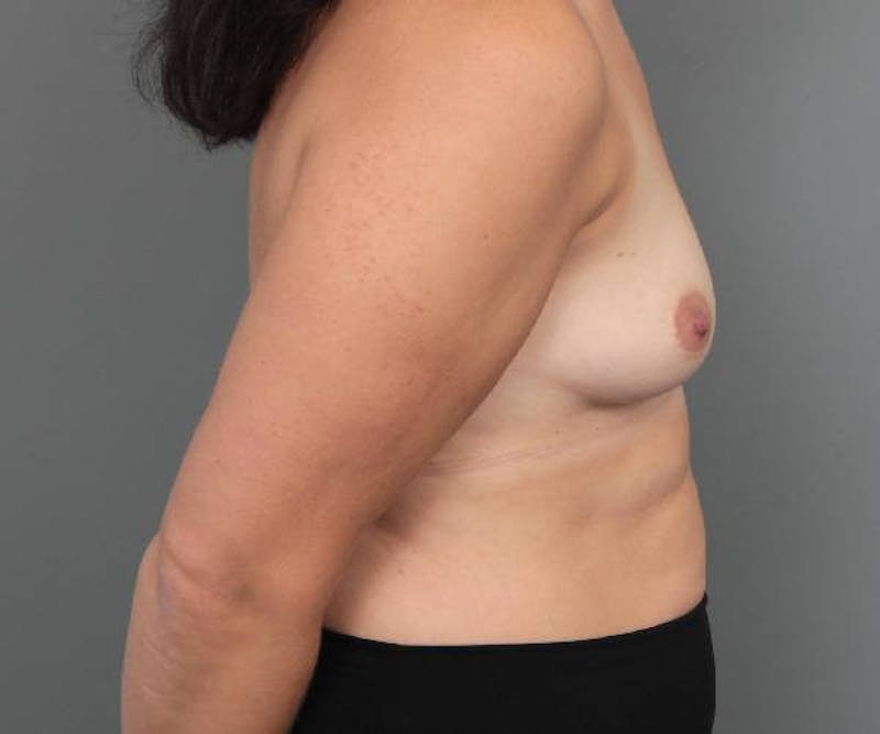 Breast Augmentation Before & After Gallery - Patient 217962 - Image 5 - Scott Chapin, MD