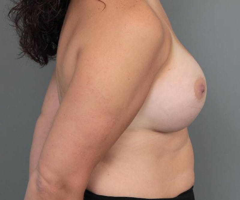 Breast Augmentation Before & After Gallery - Patient 217962 - Image 6 - Scott Chapin, MD