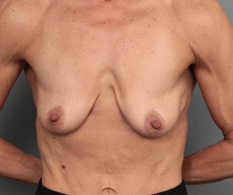 Breast Augmentation Before & After Gallery - Patient 200016 - Image 1 - Scott Chapin, MD