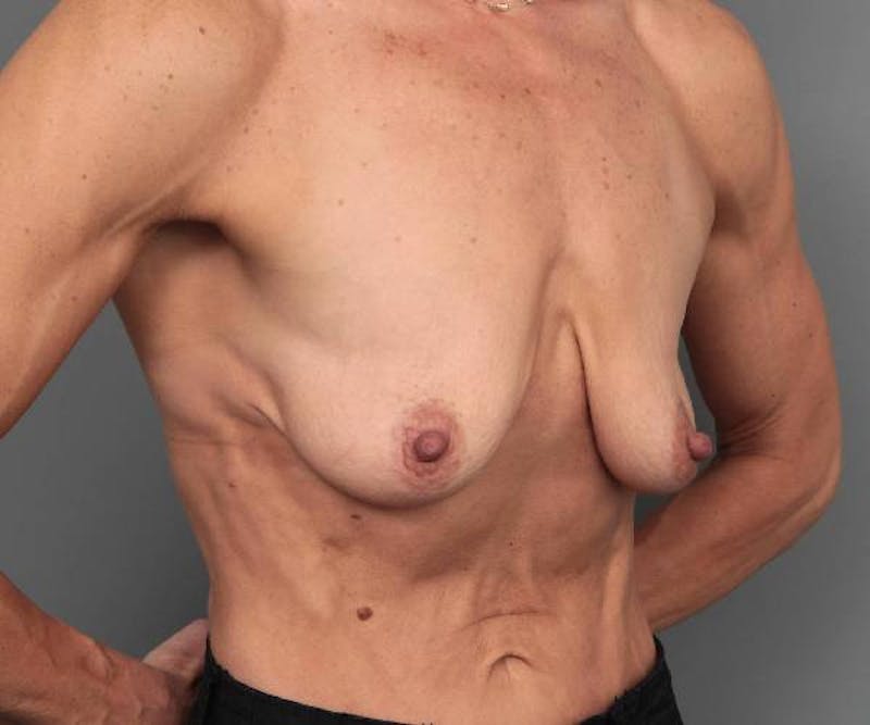 Breast Augmentation Before & After Gallery - Patient 200016 - Image 3 - Scott Chapin, MD