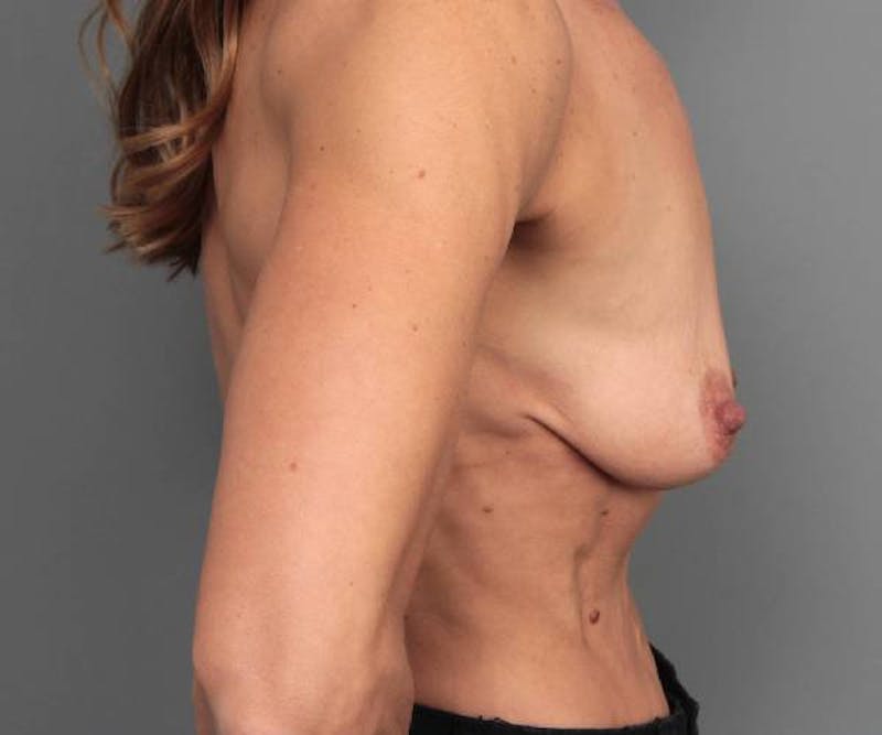 Breast Augmentation Before & After Gallery - Patient 200016 - Image 5 - Scott Chapin, MD