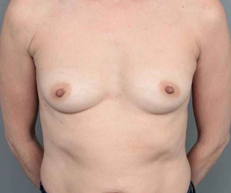 Breast Augmentation Before & After Gallery - Patient 132444 - Image 1 - Scott Chapin, MD