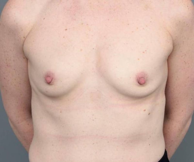 Breast Augmentation Before & After Gallery - Patient 133967 - Image 1 - Scott Chapin, MD