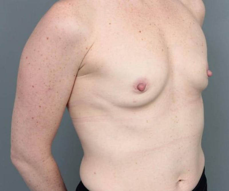 Breast Augmentation Before & After Gallery - Patient 133967 - Image 3 - Scott Chapin, MD