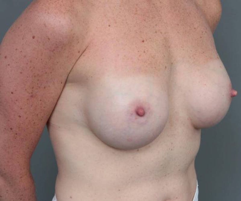 Breast Augmentation Before & After Gallery - Patient 133967 - Image 4 - Scott Chapin, MD