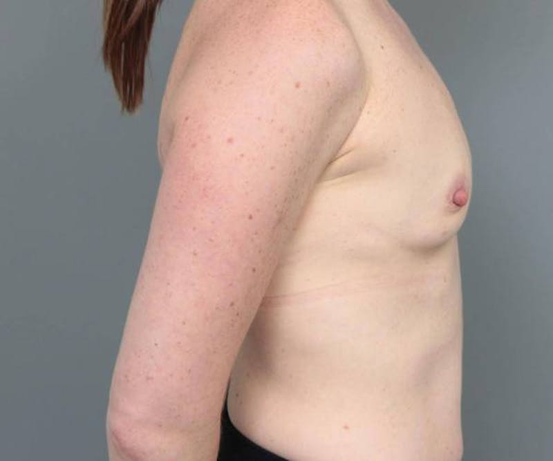 Breast Augmentation Before & After Gallery - Patient 133967 - Image 5 - Scott Chapin, MD